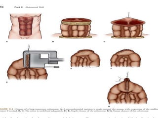 Simple Loop Colostomy Loop Colostomy Reversal