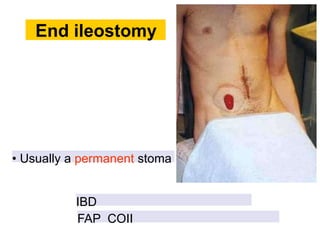 End ileostomy
• Usually a permanent stoma
IBD
FAP COII
 