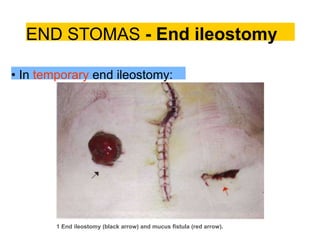 END STOMAS - End ileostomy
• In temporary end ileostomy:
1 End ileostomy (black arrow) and mucus fistula (red arrow).
 