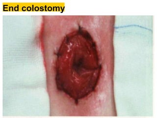 End colostomy
 