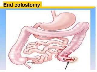 End colostomy
Colostomy
 