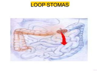 LOOP STOMAS
 