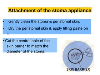 Attachment of the stoma appliance
• Gently clean the stoma & peristomal skin.
• Dry the peristomal skin & apply filling paste on
it.
• Cut the central hole of the
skin barrier to match the
diameter of the stoma.
 
