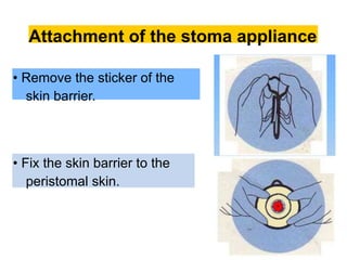 Attachment of the stoma appliance
• Remove the sticker of the
skin barrier.
• Fix the skin barrier to the
peristomal skin.
 