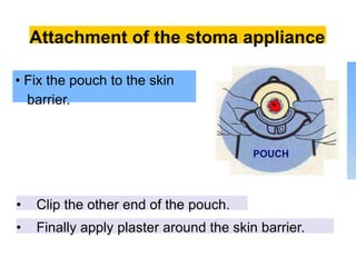 Attachment of the stoma appliance
• Fix the pouch to the skin
barrier.
• Clip the other end of the pouch.
• Finally apply plaster around the skin barrier.
POUCH
 