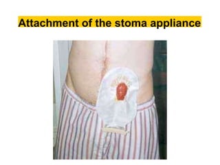 Attachment of the stoma appliance
 