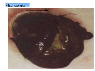 • Ischaemia
 