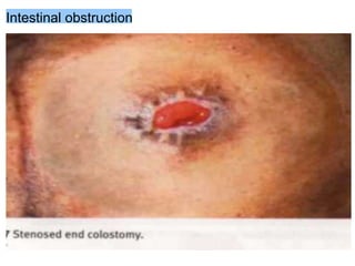 Intestinal obstruction
 