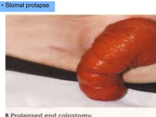 • Stomal prolapse
 