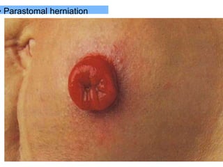 • Parastomal herniation
 
