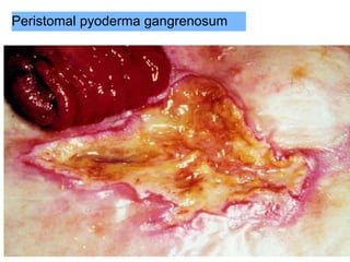 Peristomal pyoderma gangrenosum
 