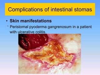 Intestinal stomas | PDF