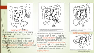Intestinal ( Bowel) strangulation | PPTX