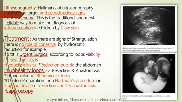 How Can Strangulation Of The Bowel Occur? – FLUM