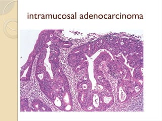 Intestinal tumors. Benign and malignant t | PPTX