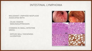 Intestinal tumors Pathoanatomy Presentation.pptx