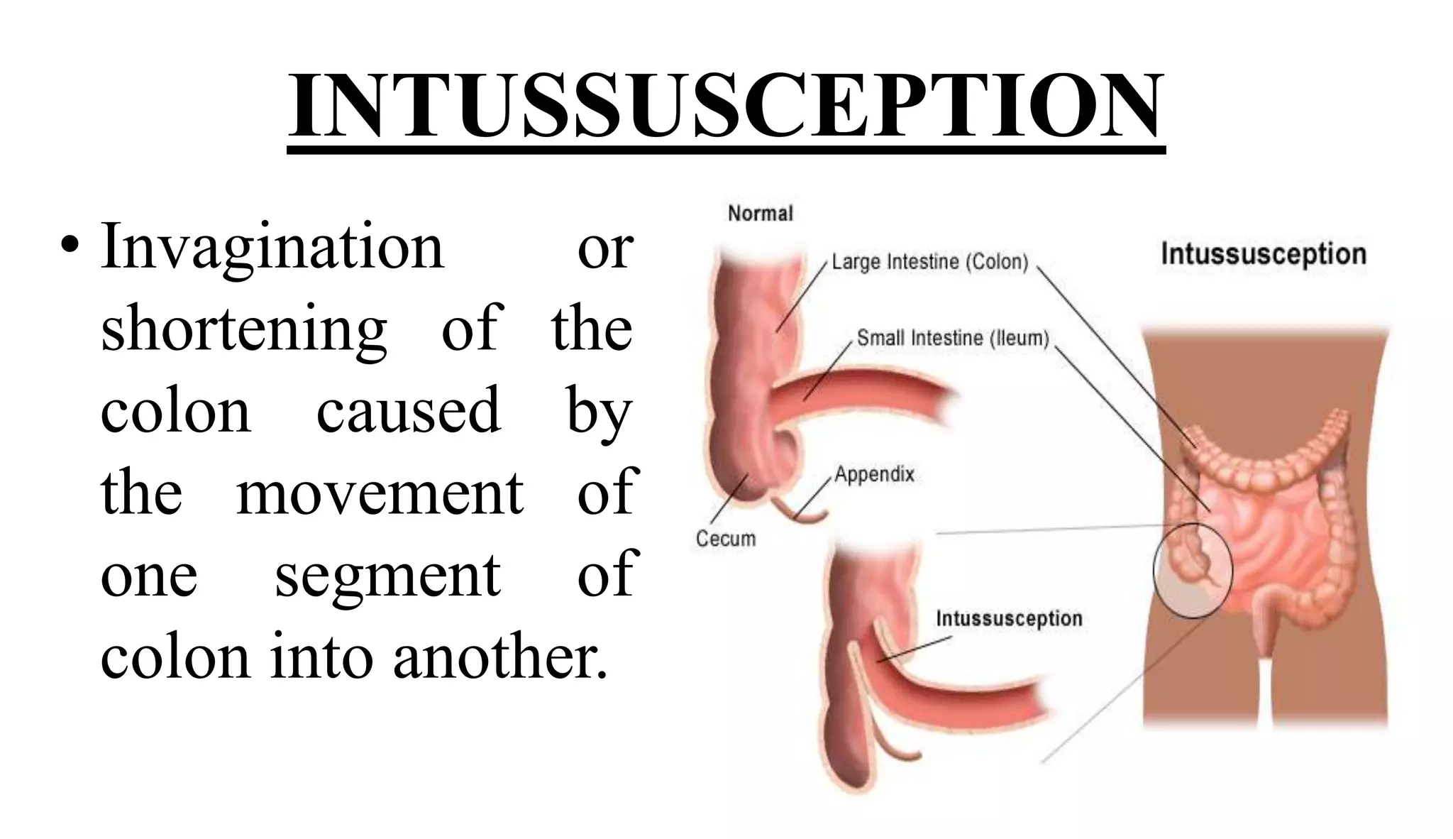 Colon Intesseption INTESTINE OBSTRUCTION.pptx