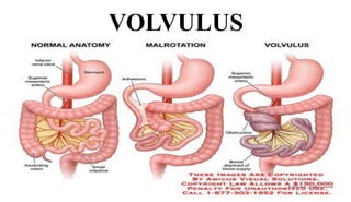 Volvulus Definition INTESTINE OBSTRUCTION.pptx