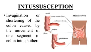 Inversion Intestine INTESTINE OBSTRUCTION.pptx