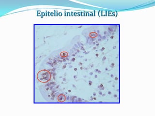 Enfermedad celíacaPatogénesis Predisposición genética