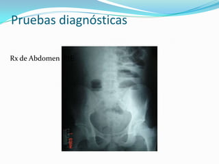 Pruebas diagnósticas Rx de Abdomen  PIE 