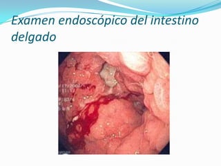 Examen endoscópico del intestino delgado