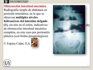 “Curso de Anatomía Humana:
     Carrera de Médico Cirujano”


Obstrucción intestinal mecánica
Radiografía simple de abdomen en
posición ortostática, en la que se
observan múltiples niveles
hidroaéreos del intestino delgado
(1), sin aire en el colon, indicativos   (1)
de obstrucción intestinal mecánica
completa, en este caso por peritonitis
plástica (con bridas posquirúrgicas)

© Espasa Calpe, S.A.




                                          61
 