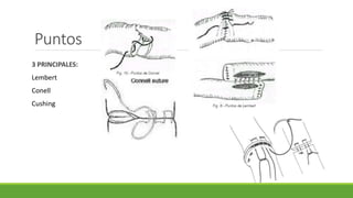 3 PRINCIPALES:
Lembert
Conell
Cushing
Puntos
 