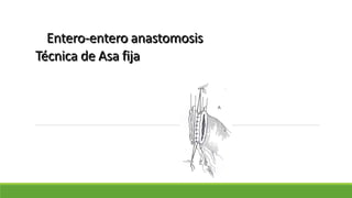 Entero-entero anastomosis
Técnica de Asa fija
 