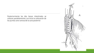 Posteriormente las dos bocas intestinales se
colocan paralelamente y se inicia la colocación de
los puntos sero-serosa de la cara posterior.
 