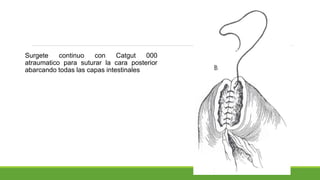 Surgete continuo con Catgut 000
atraumatico para suturar la cara posterior
abarcando todas las capas intestinales
 