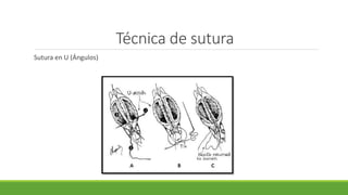 Técnica de sutura
Sutura en U (Ángulos)
 