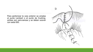 Para peritonizar la cara anterior se emplea
el punto Lembert o el punto de Cushing,
ambas son sero-serosa y se deben suturar
con seda 000.
 