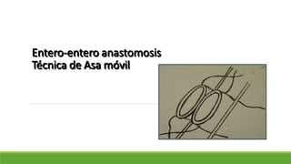 Entero-entero anastomosis
Técnica de Asa móvil
 