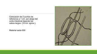 Colocación de 2 puntos de
referencia a 1 cm. por abajo del
corte intestinal dejando los
cabos largos (10 cm. aprox.).
Material seda 000
 