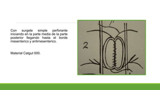 Con surgete simple perforante
iniciando en la parte media de la parte
posterior llegando hasta el borde
mesenterico y antimesenterico.
Material Catgut 000.
 