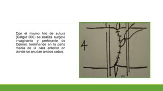 Con el mismo hilo de sutura
(Catgut 000) se realiza surgete
invaginante y perforante de
Connel, terminando en la parte
media de la cara anterior en
donde se anudan ambos cabos.
 