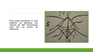Para poder peritonizar la cara
posterior se efectuara una
rotación de 180º traccionando
para ello los puntos de
referencia.
 