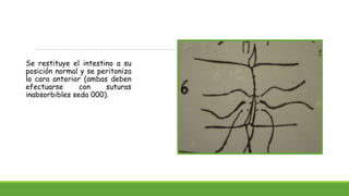 Se restituye el intestino a su
posición normal y se peritoniza
la cara anterior (ambas deben
efectuarse con suturas
inabsorbibles seda 000).
 