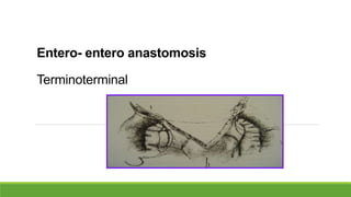 Entero- entero anastomosis
Terminoterminal
 