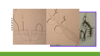 Los bordes antimesentéricos del
intestino delgado cortado se
fijan con pinzas Babcock, y se
pone el punto de colchonero,
para coaptación mesentérica,
con seda 0000.
 