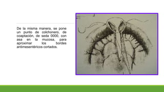 De la misma manera, se pone
un punto de colchonero, de
coaptación, de seda 0000, con
asa en la mucosa, para
aproximar los bordes
antimesentéricos cortados.
 