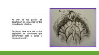 Al tirar de los puntos de
coaptación, se juntan los bordes
cortados del intestino.
Se ponen una serie de puntos
separados de colchonero que
comprenden toda la pared y
causan eversión.
 