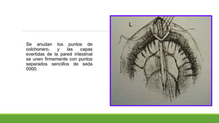 Se anudan los puntos de
colchonero, y las capas
evertidas de la pared intestinal
se unen firmemente con puntos
separados sencillos de seda
0000.
 