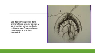 Los dos últimos puntos de la
primera hilera anterior se atan y
se circundan por un punto de
colchonero en 8 para refuerzo,
para asegurar la sutura
hermética.
 