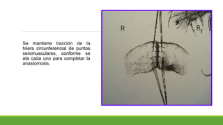 Se mantiene tracción de la
hilera circunferencial de puntos
seromusculares, conforme se
ata cada uno para completar la
anastomosis.
 