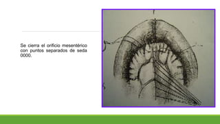 Se cierra el orificio mesentérico
con puntos separados de seda
0000.
 