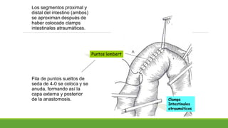 Los segmentos proximal y
distal del intestino (ambos)
se aproximan después de
haber colocado clamps
intestinales atraumàticas.
Fila de puntos sueltos de
seda de 4-0 se coloca y se
anuda, formando así la
capa externa y posterior
de la anastomosis. Clamps
Intestinales
atraumáticos
Puntos lembert
 