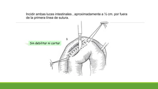 Incidir ambas luces intestinales , aproximadamente a ½ cm. por fuera
de la primera línea de sutura.
Sin debilitar ni cortar
 