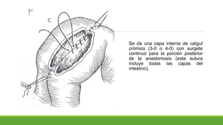 Se da una capa interna de catgut
crómico (3-0 o 4-0) con surgete
continuo para la porción posterior
de la anastomosis (esta sutura
incluye todas las capas del
intestino).
 